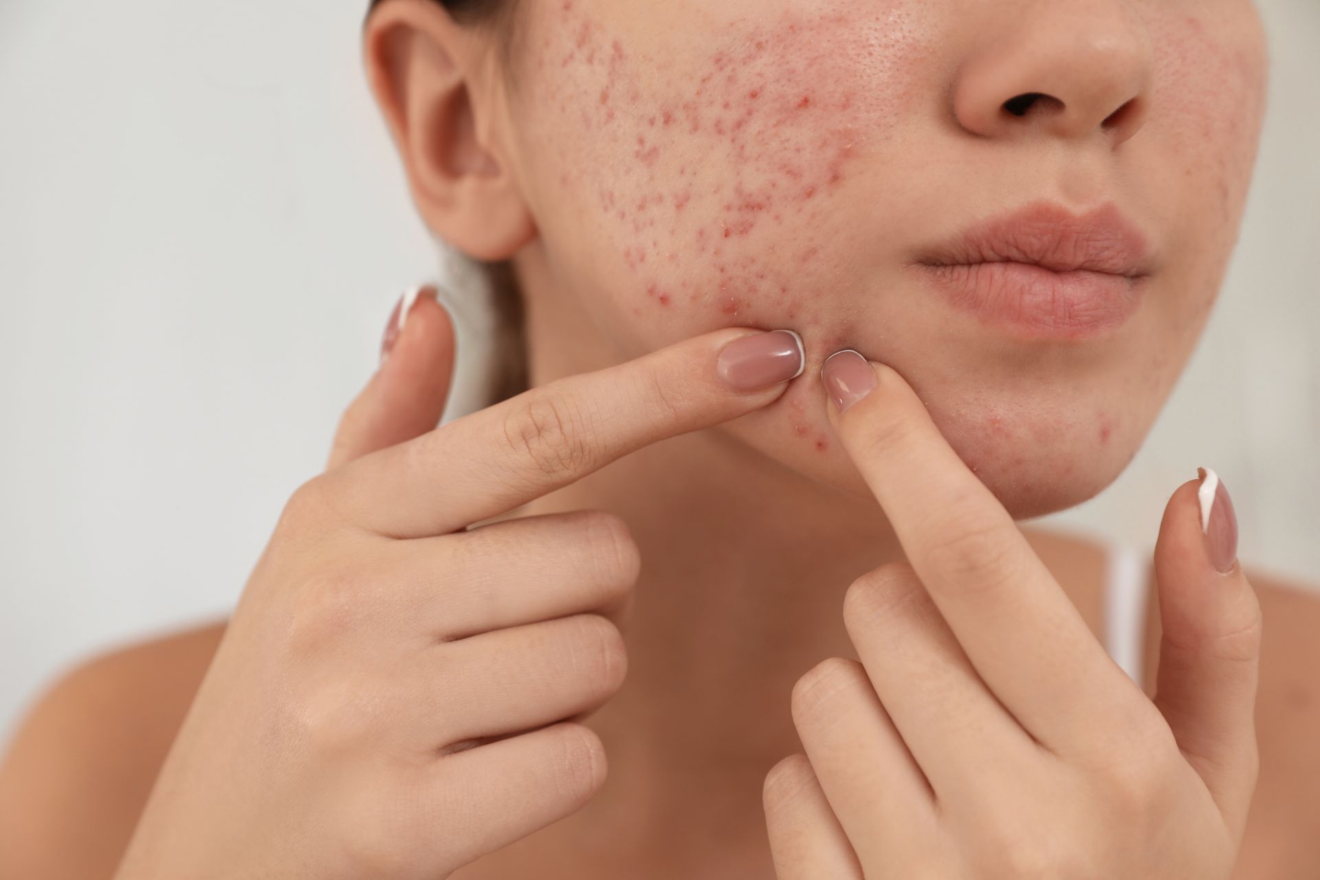 Acne treatment in Linköping