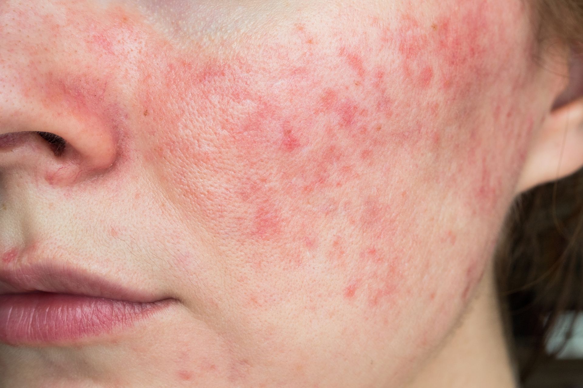 Rosacea